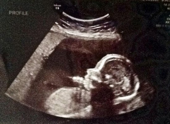 22-week-ultrasound